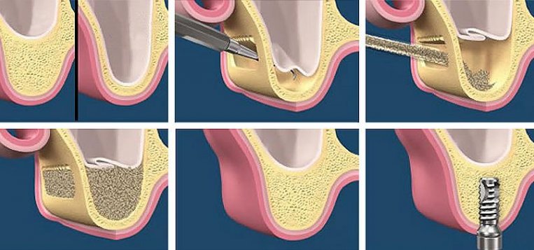 sinus lifting and bone grafting