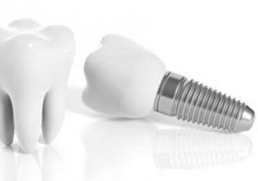 benefits of dental implants