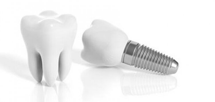 benefits of dental implants