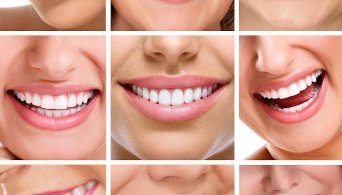 All About Dental Veneers