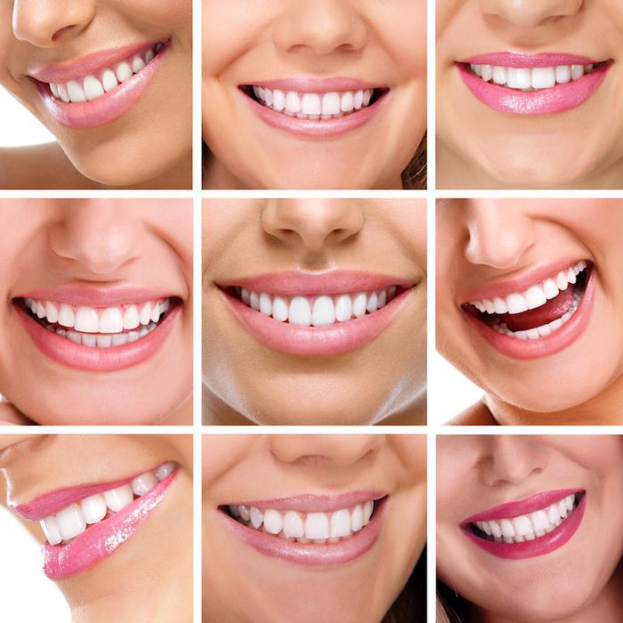All About Dental Veneers