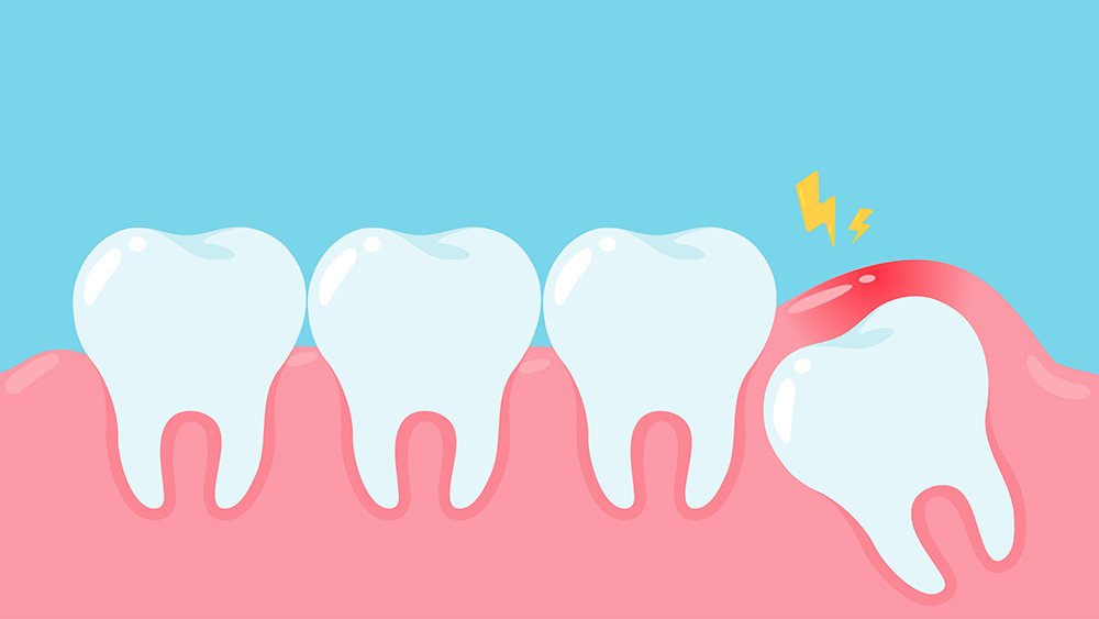 All About Wisdom Teeth