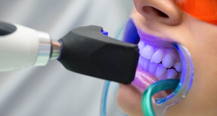 Teeth Whitening