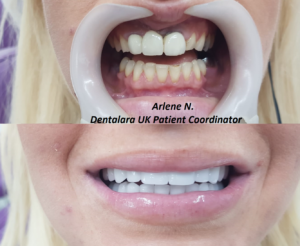Before After Zirconium 1