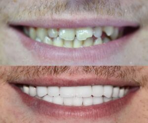Before After Zirconium 10