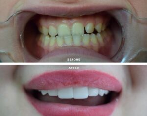 Before After Zirconium 12