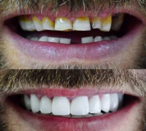 Before After Zirconium 13