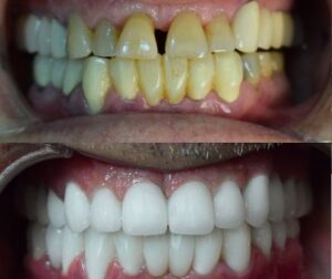 Before After Zirconium 15