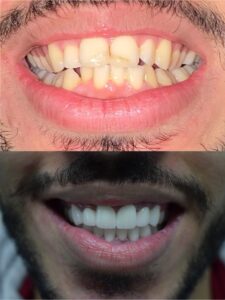 Before After Zirconium 16