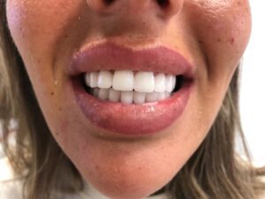 Before After Zirconium 18