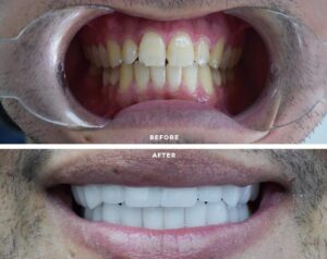 Before After Zirconium 2