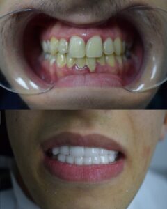 Before After Zirconium 20