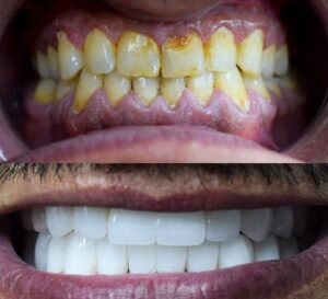 Before After Zirconium 22