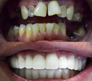 Before After Zirconium 24