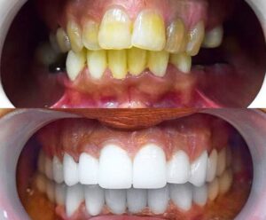 Before After Zirconium 25
