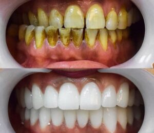 Before After Zirconium 26