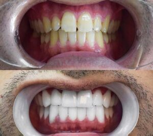 Before After Zirconium 27