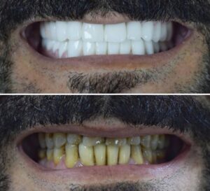 Before After Zirconium 28