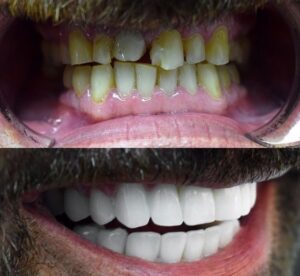 Before After Zirconium 30