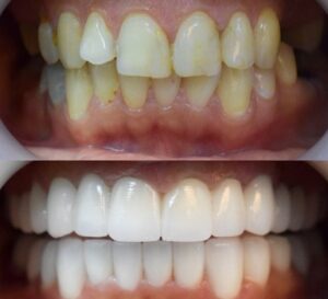 Before After Zirconium 33