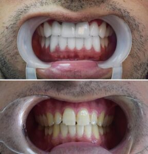 Before After Zirconium 34