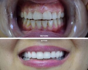 Before After Zirconium 4