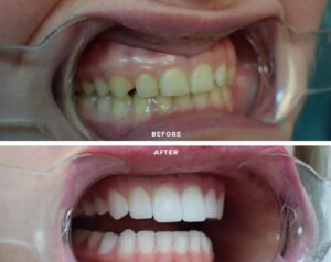 Before After Zirconium 6