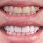 Composite Bonding in Turkey