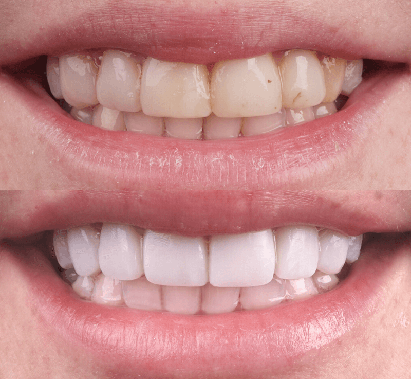 Composite Bonding in Turkey