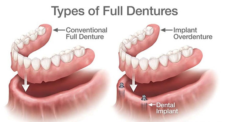 Cosmetic Dentures in Turkey