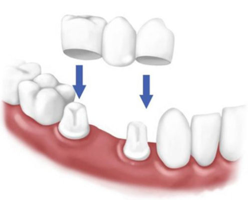 dental bridges in turkey