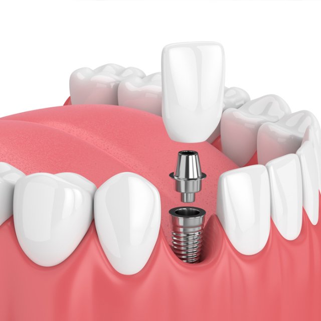dental-implants-in-turkey