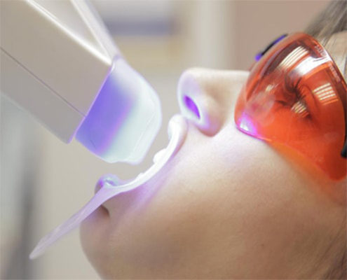 professional-teeth-whitening