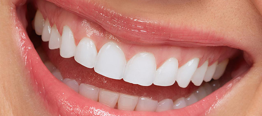 E-max veneers price