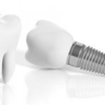 full mouth implants price in turkey