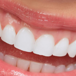 full set of veneers price in turkey