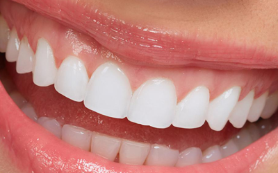 full set of veneers price in turkey