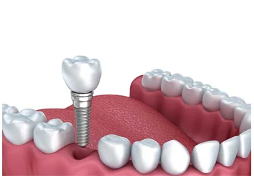 Dental Implants in Turkey