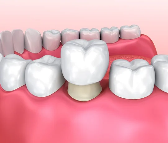 Dental Crowns in Turkey